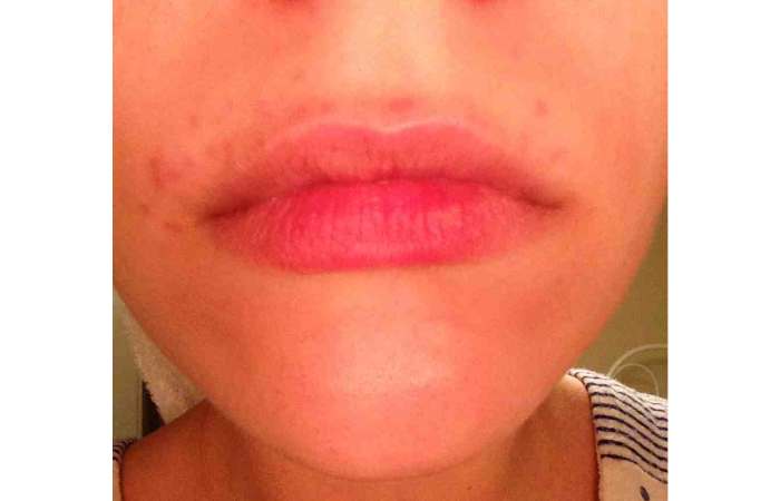 redness and irritation