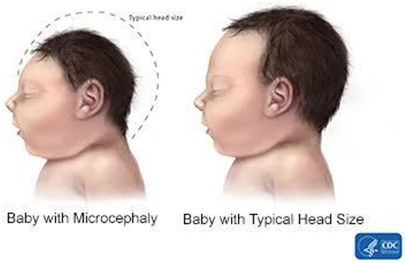 Zika virus effects human brain