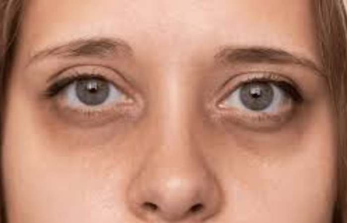 Why dark circles appear