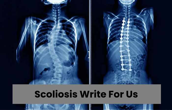 Scoliosis Write For Us