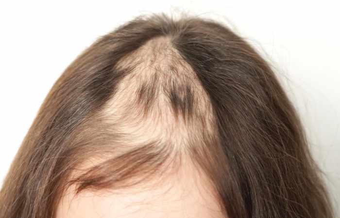 major causes of hair loss