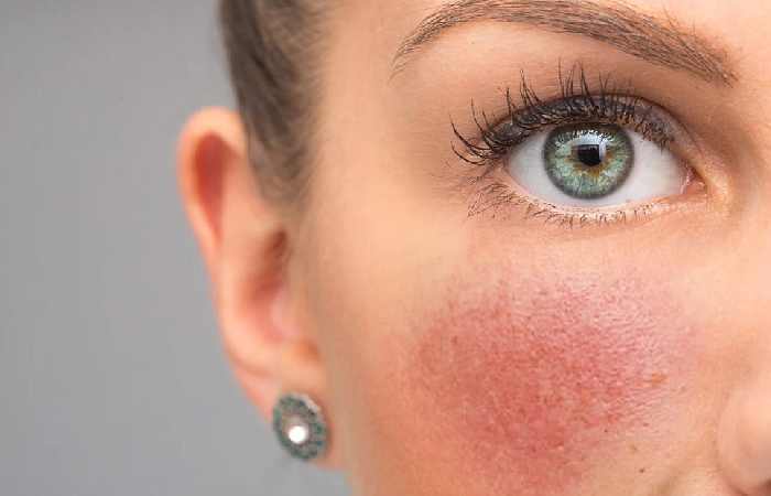 can help soothe the look of redness