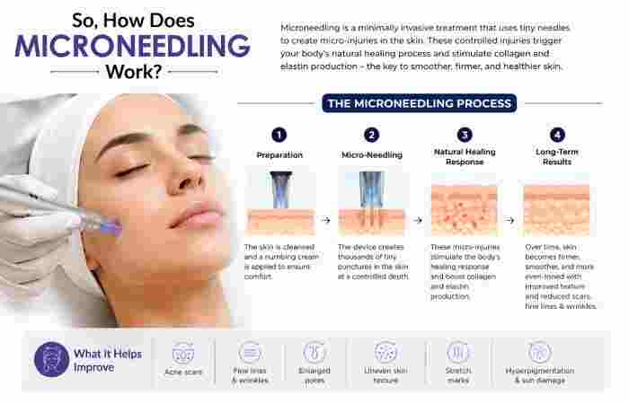so how does microneedling work