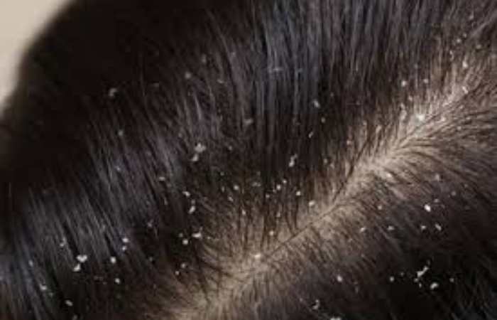 what is dandruff