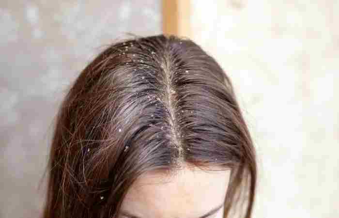 what is scalp buildup
